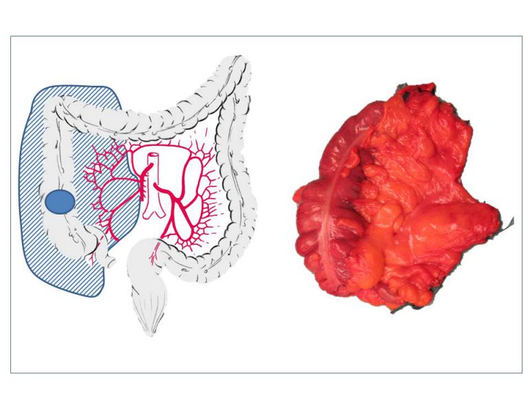KolonkarzinomHemikolektomierechts antireflux.info