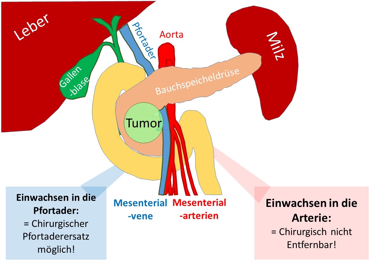 Bauchspeicheldrüsenkrebs (Pankreaskarzinom) – antireflux.info