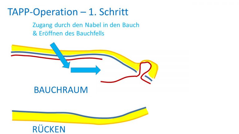 Leistenhernie: OP-Verfahren – antireflux.info